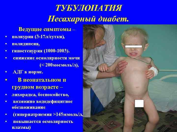 ТУБУЛОПАТИЯ Несахарный диабет. Ведущие симптомы – • полиурия (3 -17 л/сутки), • полидипсия, •