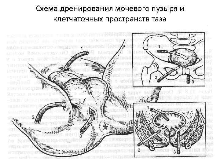 Схема дренирования мочевого пузыря и клетчаточных пространств таза 