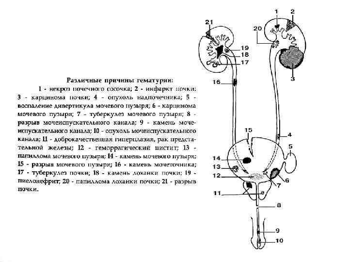 Причины гематурии 17 