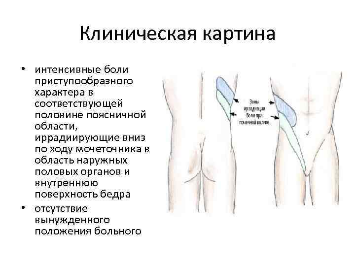 Клиническая картина • интенсивные боли приступообразного характера в соответствующей половине поясничной области, иррадиирующие вниз