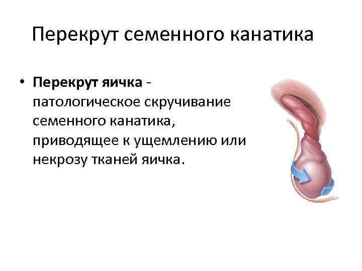  Перекрут семенного канатика • Перекрут яичка - патологическое скручивание семенного канатика, приводящее к