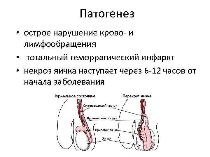 Патогенез • острое нарушение крово- и лимфообращения • тотальный геморрагический инфаркт • некроз яичка