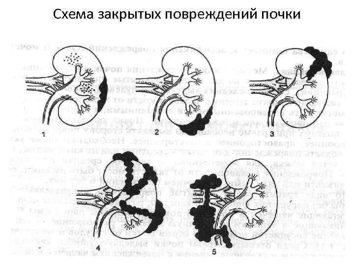 Схема закрытых повреждений почки 