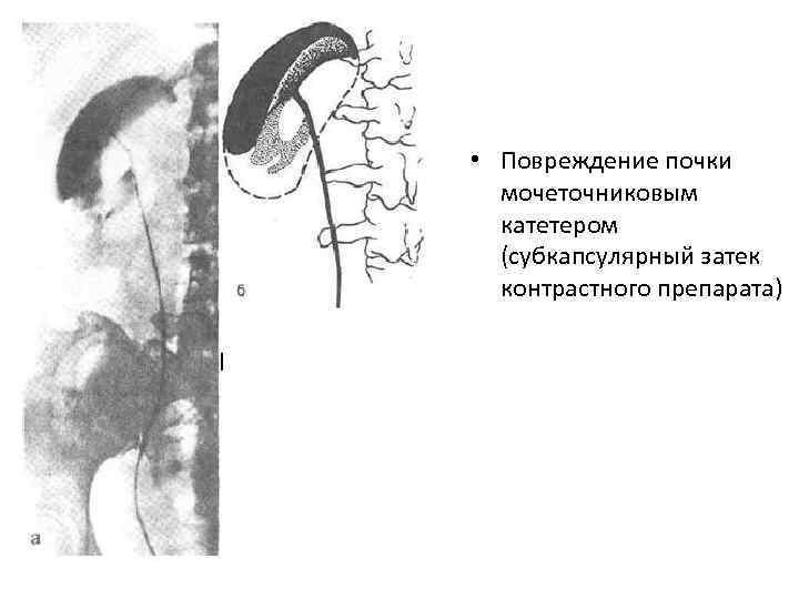 • Повреждение почки мочеточниковым катетером (субкапсулярный затек контрастного препарата) 
