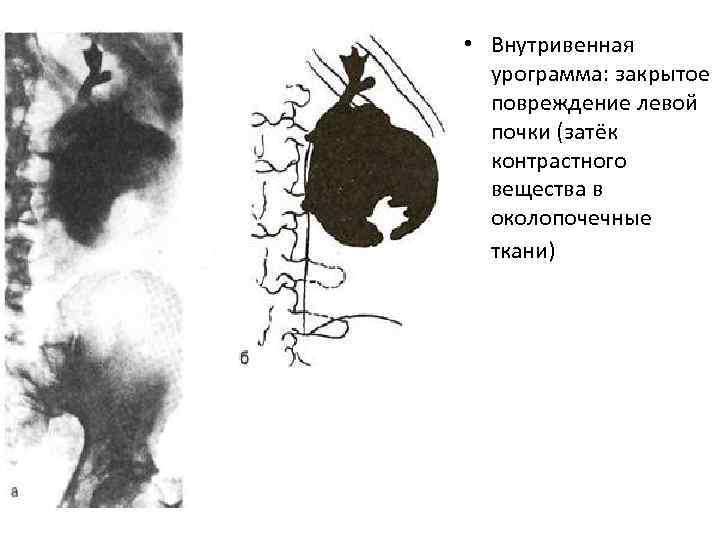  • Внутривенная урограмма: закрытое повреждение левой почки (затёк контрастного вещества в околопочечные ткани)