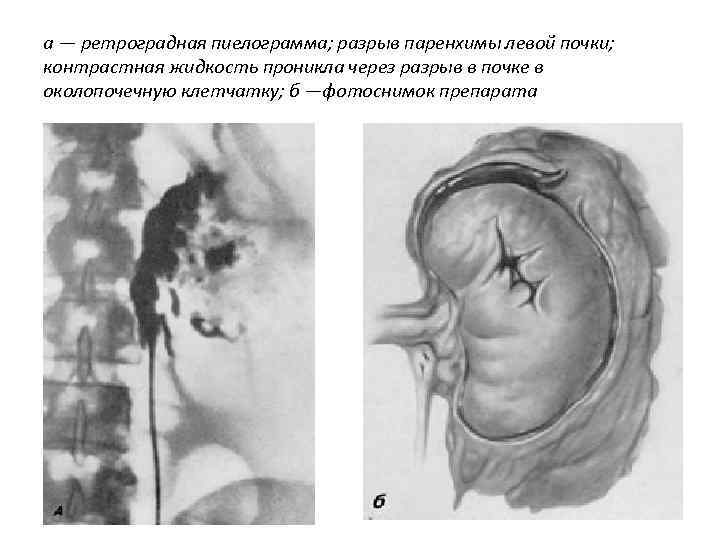 а — ретроградная пиелограмма; разрыв паренхимы левой почки; контрастная жидкость проникла через разрыв в