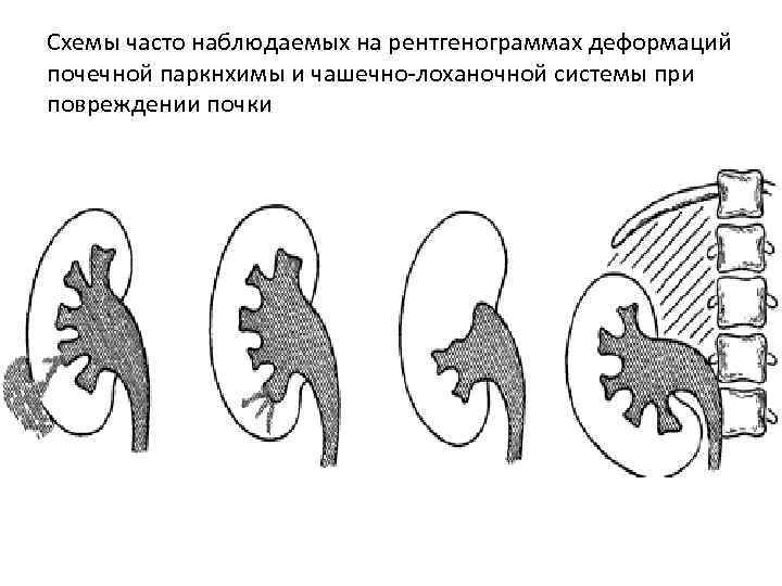 Схемы часто наблюдаемых на рентгенограммах деформаций почечной паркнхимы и чашечно-лоханочной системы при повреждении почки