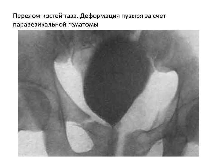 Перелом костей таза. Деформация пузыря за счет паравезикальной гематомы 
