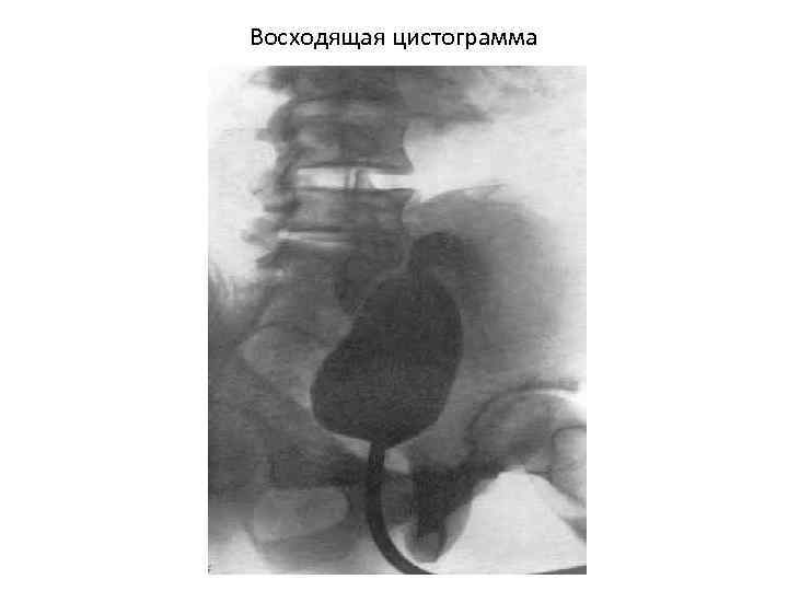 Восходящая цистограмма 