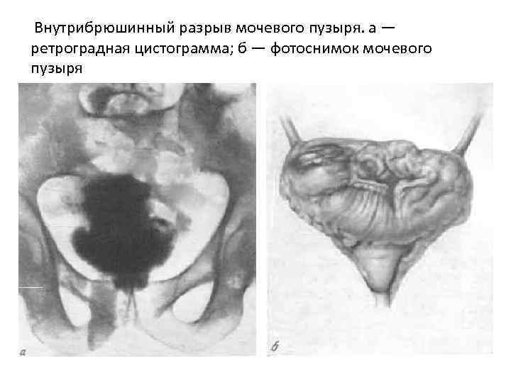  Внутрибрюшинный разрыв мочевого пузыря. а — ретроградная цистограмма; б — фотоснимок мочевого пузыря