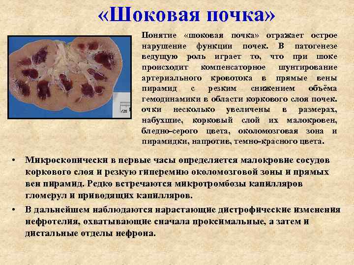 «Шоковая почка» Понятие «шоковая почка» отражает острое нарушение функции почек. В патогенезе ведущую