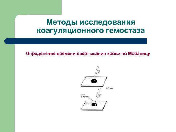 Методы исследования коагуляционного гемостаза Определение времени свертывания крови по Моравицу 