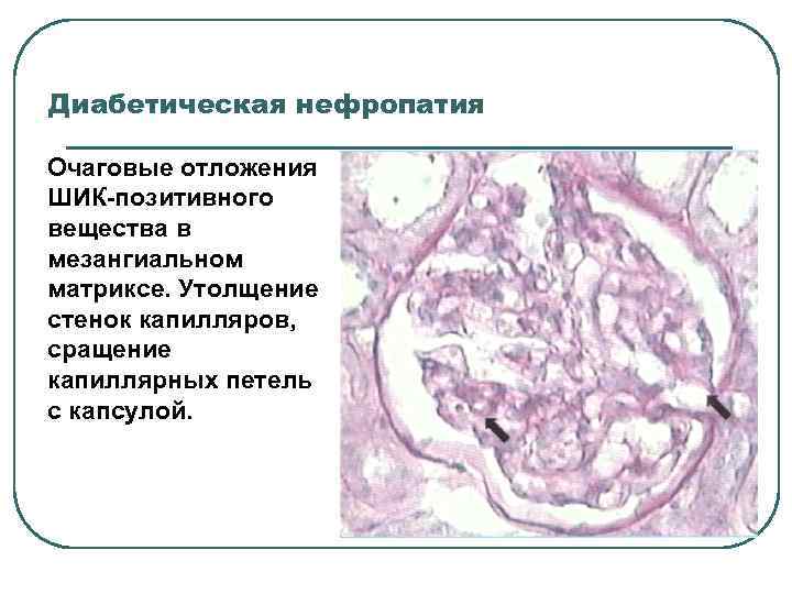 Диабетическая нефропатия Очаговые отложения ШИК-позитивного вещества в мезангиальном матриксе. Утолщение стенок капилляров, сращение капиллярных