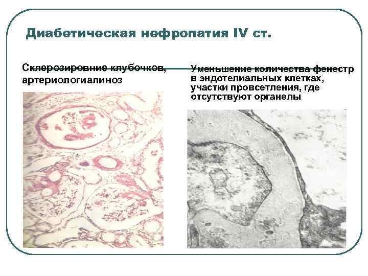 Диабетическая нефропатия IV ст. Склерозировние клубочков, артериологиалиноз Уменьшение количества фенестр в эндотелиальных клетках, участки