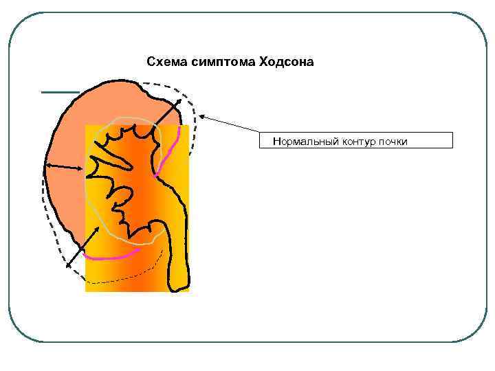 Схема симптома Ходсона Нормальный контур почки 