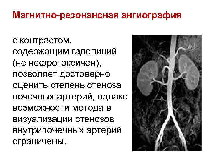 Магнитно-резонансная ангиография с контрастом, содержащим гадолиний (не нефротоксичен), позволяет достоверно оценить степень стеноза почечных