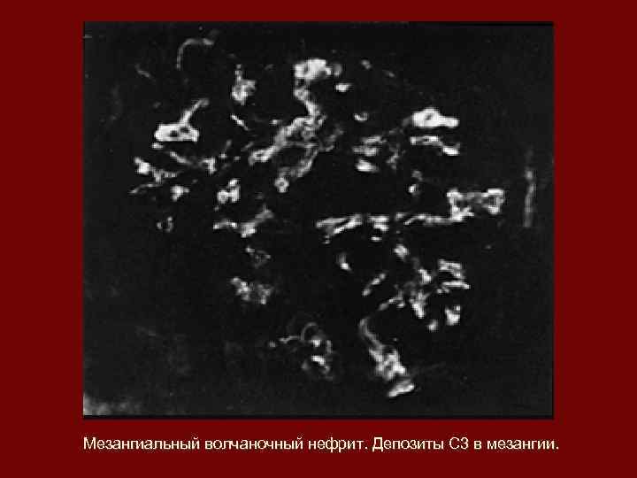 Мезангиальный волчаночный нефрит. Депозиты С 3 в мезангии. 