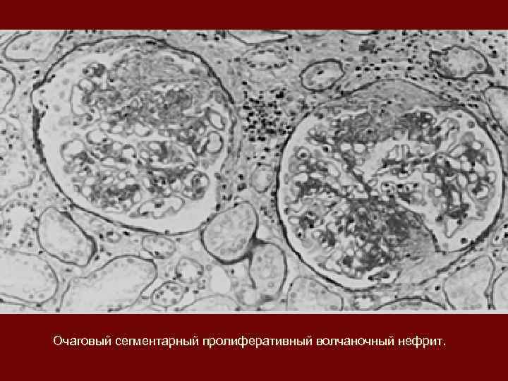 Очаговый сегментарный пролиферативный волчаночный нефрит. 