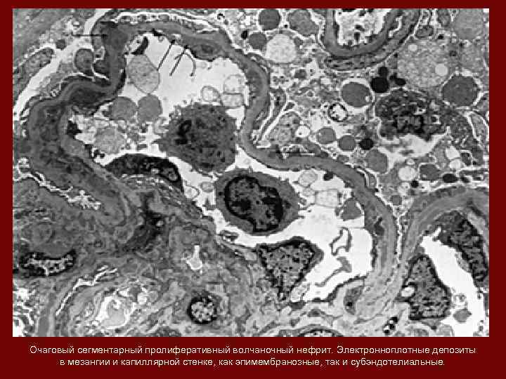 Очаговый сегментарный пролиферативный волчаночный нефрит. Электронноплотные депозиты в мезангии и капиллярной стенке, как эпимембранозные,