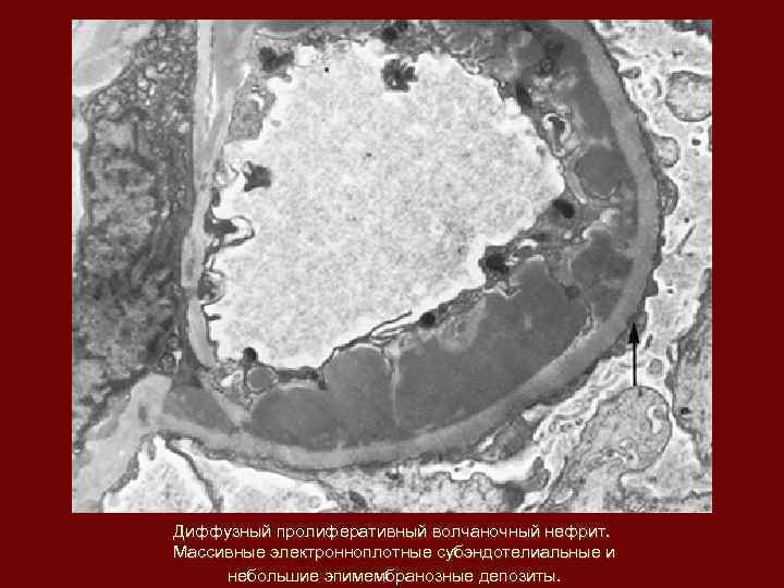 Диффузный пролиферативный волчаночный нефрит. Массивные электронноплотные субэндотелиальные и небольшие эпимембранозные депозиты. 