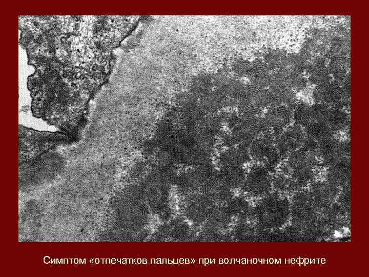 Симптом «отпечатков пальцев» при волчаночном нефрите 