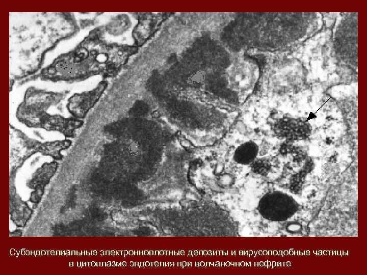 Субэндотелиальные электронноплотные депозиты и вирусоподобные частицы в цитоплазме эндотелия при волчаночном нефрите 