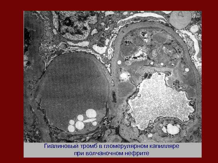 Гиалиновый тромб в гломерулярном капилляре при волчаночном нефрите 