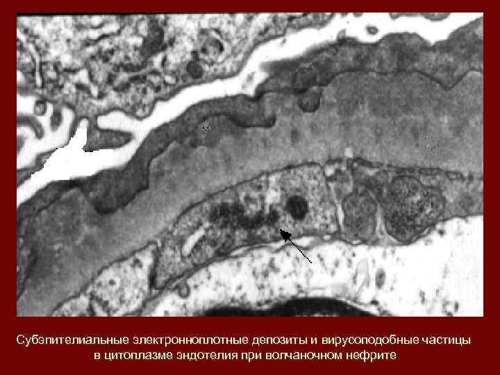 Субэпителиальные электронноплотные депозиты и вирусоподобные частицы в цитоплазме эндотелия при волчаночном нефрите 