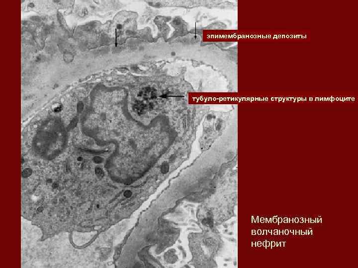эпимембранозные депозиты тубуло-ретикулярные структуры в лимфоците Мембранозный волчаночный нефрит 