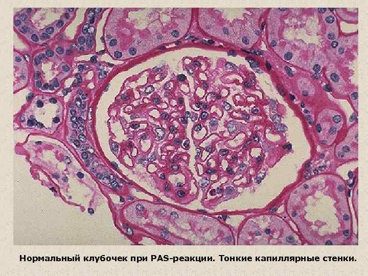 Нормальный клубочек при PAS-реакции. Тонкие капиллярные стенки. 