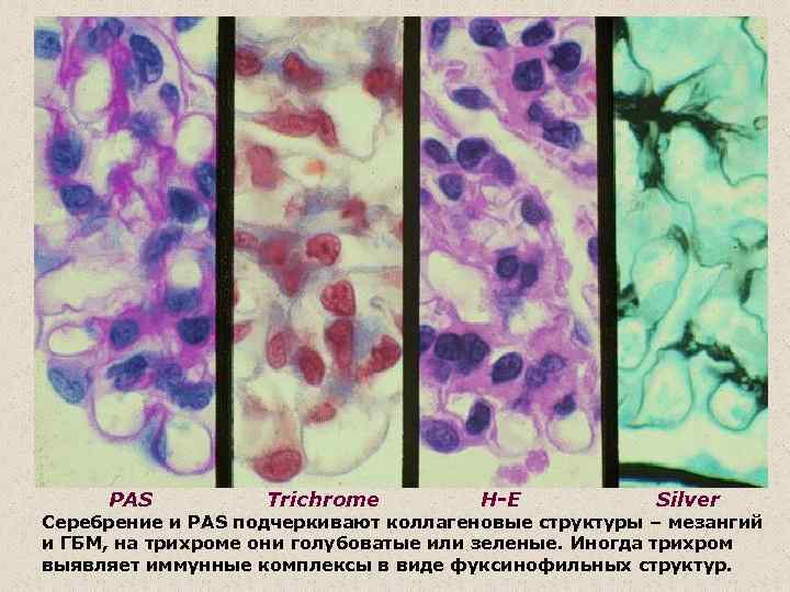PAS Trichrome H-E Silver Cеребрение и PAS подчеркивают коллагеновые структуры – мезангий и ГБМ,