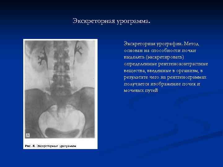 Экскреторная урограмма. Экскреторная урография. Метод основан на способности почки выделять (экскретировать) определенные рентгеноконтрастные вещества,