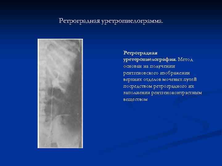 Ретроградная уретропиелограмма. Ретроградная уретеропиелография. Метод основан на получении рентгеновского изображения верхних отделов мочевых путей