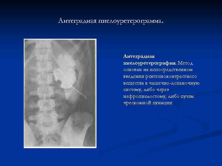 Антеградная пиелоуретерограмма. Антеградная пиелоуретерография. Метод основан на непосредственном введении рентгеноконтрастного вещества в чашечно-лоханочную систему,