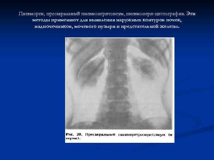 Пневморен, пресакральный пневмоперитонеум, пневмопери-цистография. Эти методы применяют для выявления наружных контуров почек, надпочечников, мочевого