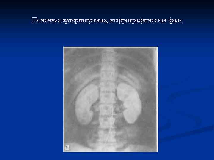 Почечная артериограмма, нефрографическая фаза 