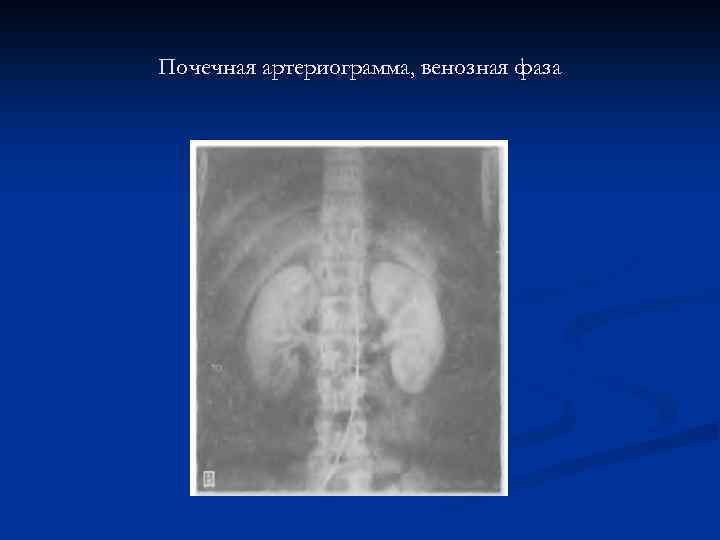 Почечная артериограмма, венозная фаза 