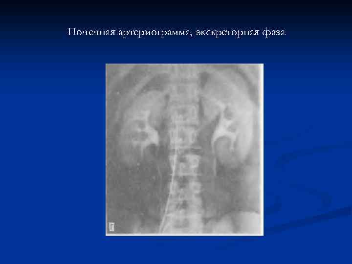 Почечная артериограмма, экскреторная фаза 