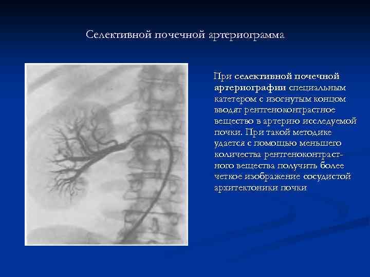 Селективной почечной артериограмма При селективной почечной артериографии специальным катетером с изогнутым концом вводят рентгеноконтрастное