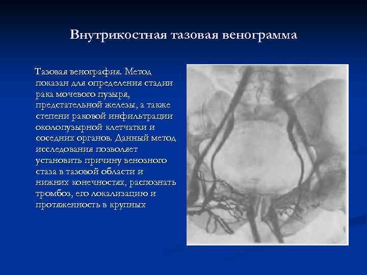 Внутрикостная тазовая венограмма Тазовая венография. Метод показан для определения стадии рака мочевого пузыря, предстательной