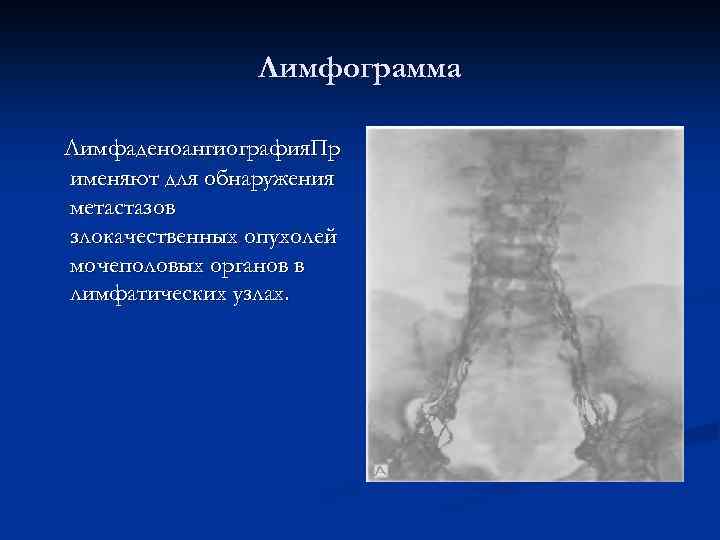 Лимфограмма Лимфаденоангиография. Пр именяют для обнаружения метастазов злокачественных опухолей мочеполовых органов в лимфатических узлах.