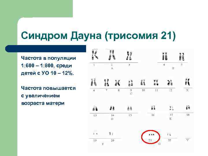 Синдром Дауна (трисомия 21) Частота в популяции 1: 600 – 1: 800, среди детей