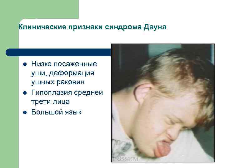 Клинические признаки синдрома Дауна l l l Низко посаженные уши, деформация ушных раковин Гипоплазия