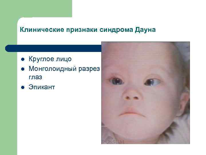 Признаки дауна у новорожденного ребенка с фото