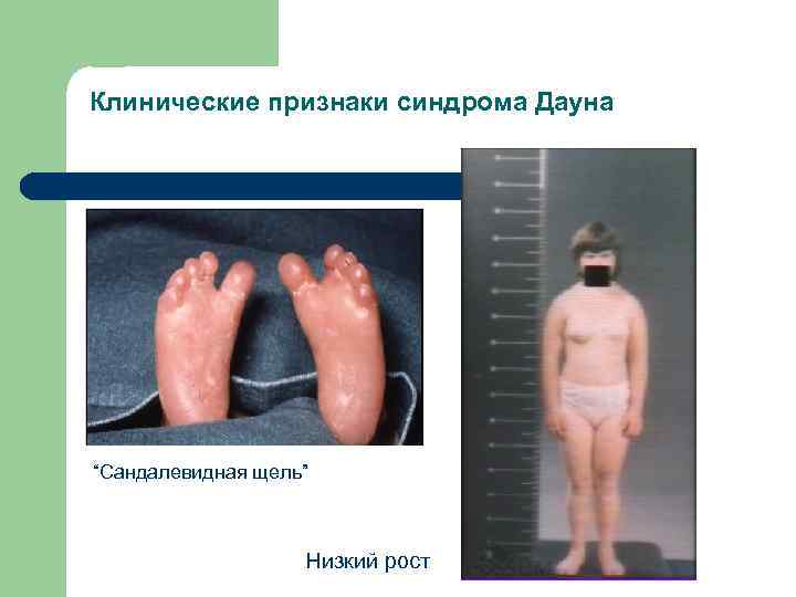 Клинические признаки синдрома Дауна “Сандалевидная щель” Низкий рост 