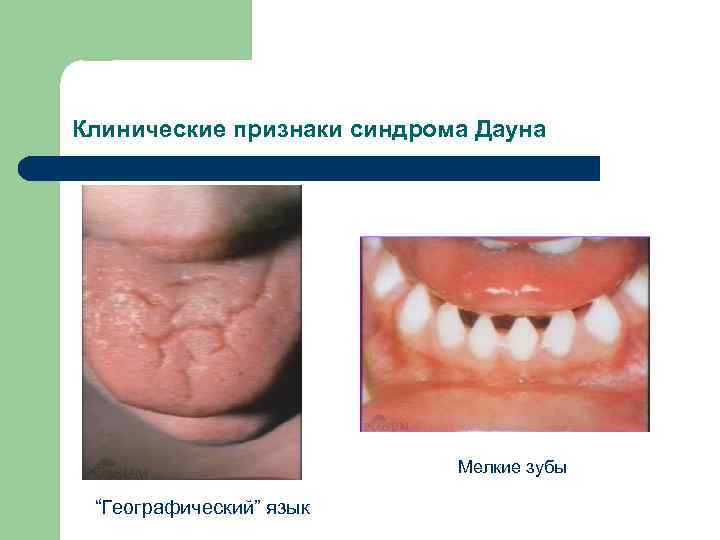 Клинические признаки синдрома Дауна Мелкие зубы “Географический” язык 