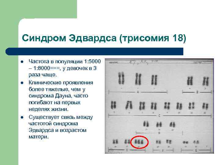 Синдром эдвардса клиническая картина