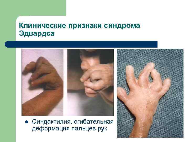 Клинические признаки синдрома Эдвардса l Синдактилия, сгибательная деформация пальцев рук 