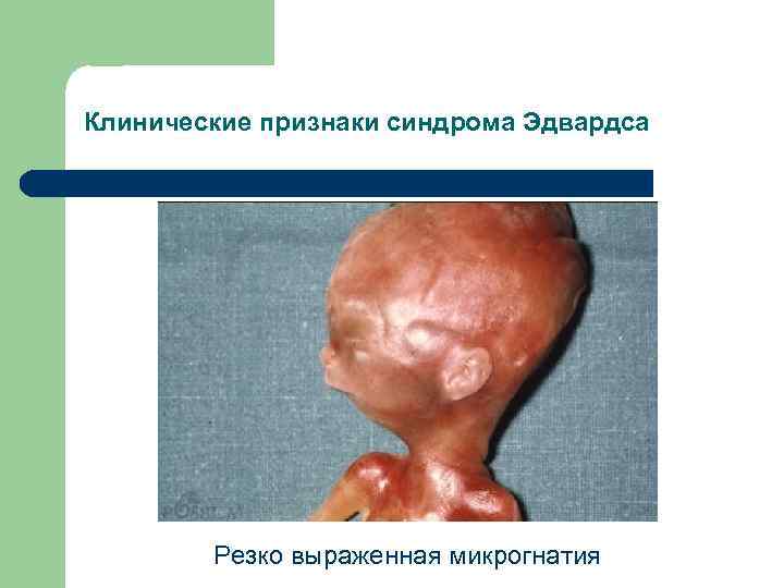 Клинические признаки синдрома Эдвардса Резко выраженная микрогнатия 