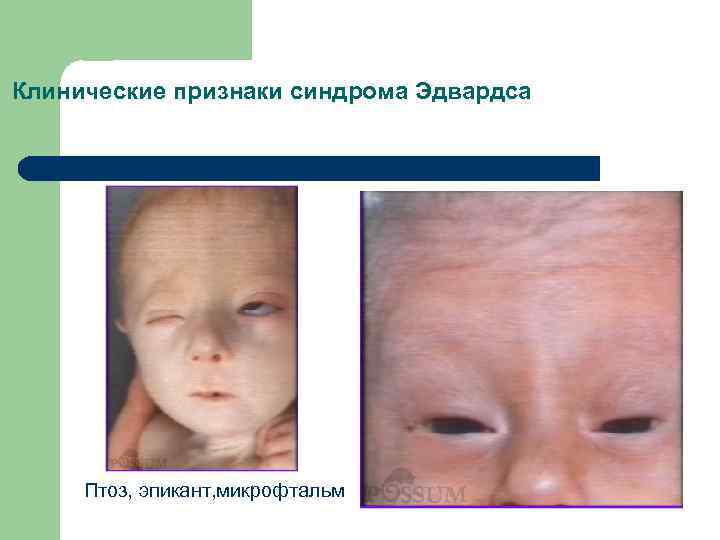 Клинические признаки синдрома Эдвардса Птоз, эпикант, микрофтальм 